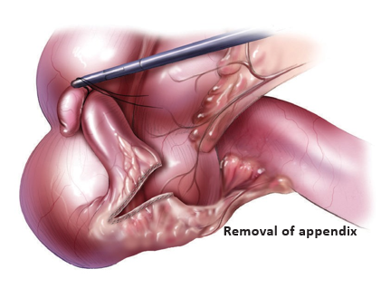 Appendix Removal Doctor in Ahmedabad
